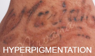 Hyperpigmentation
