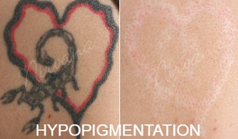 Hypopigmentation