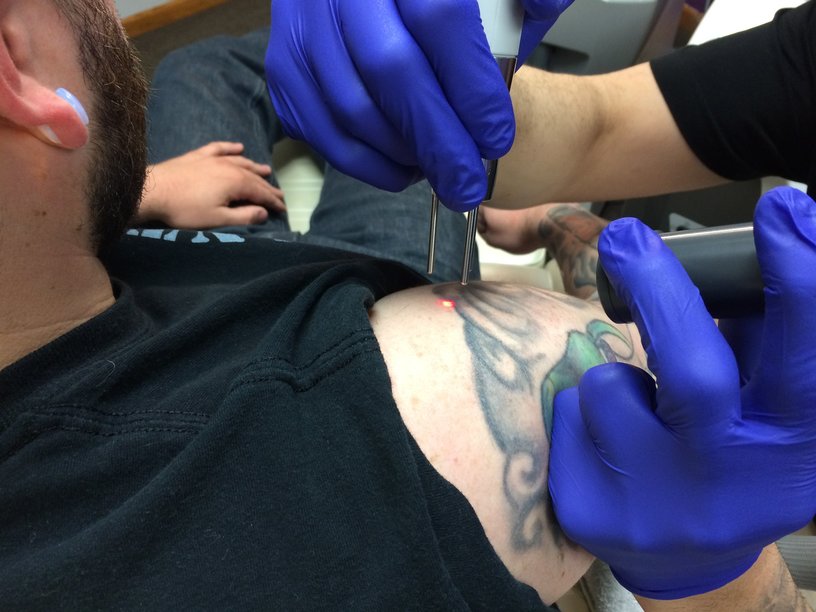 How Tattoo Removal Works
