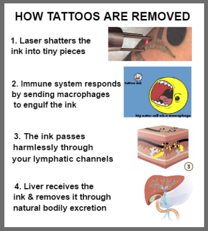 How Tattoo Removal Works