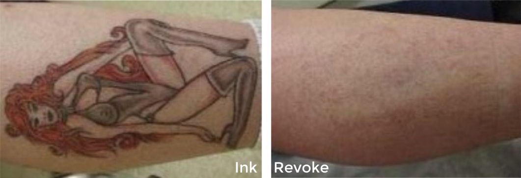 Tattoo Removal Westminster, CO