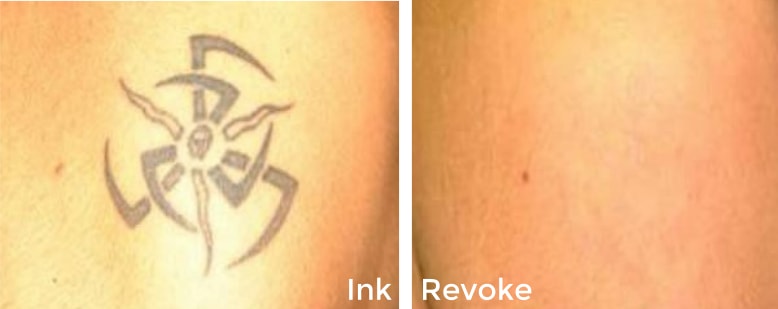 Tattoo Removal Longmont